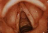 9vc acute laryngitis